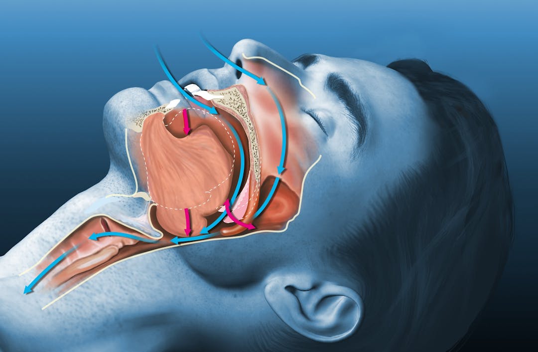 Mouth, Throat, and Tongue Exercises for Snoring